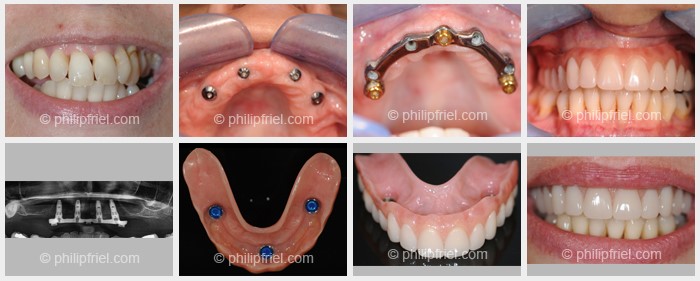 Young Dentures Before And After Orlando FL 32806